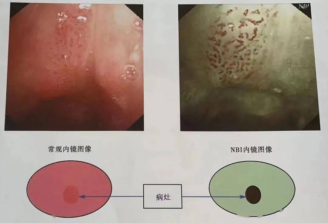咽癌早期的五大症状图片