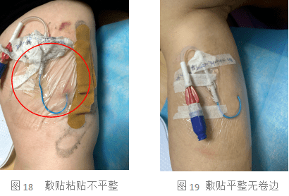 picc导管意外脱出,可能是这4大原因在作怪_患者_静脉_区域