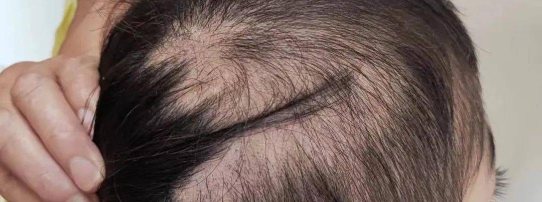 毛囊永久性消失,毛发不再生长,最终形成瘢痕性脱发,斑秃,休止期脱发