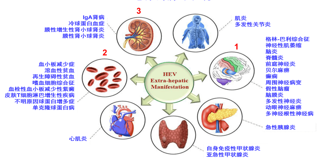 庄辉院士:《戊型肝炎防治共识》解读_阳性率_疾病_全球