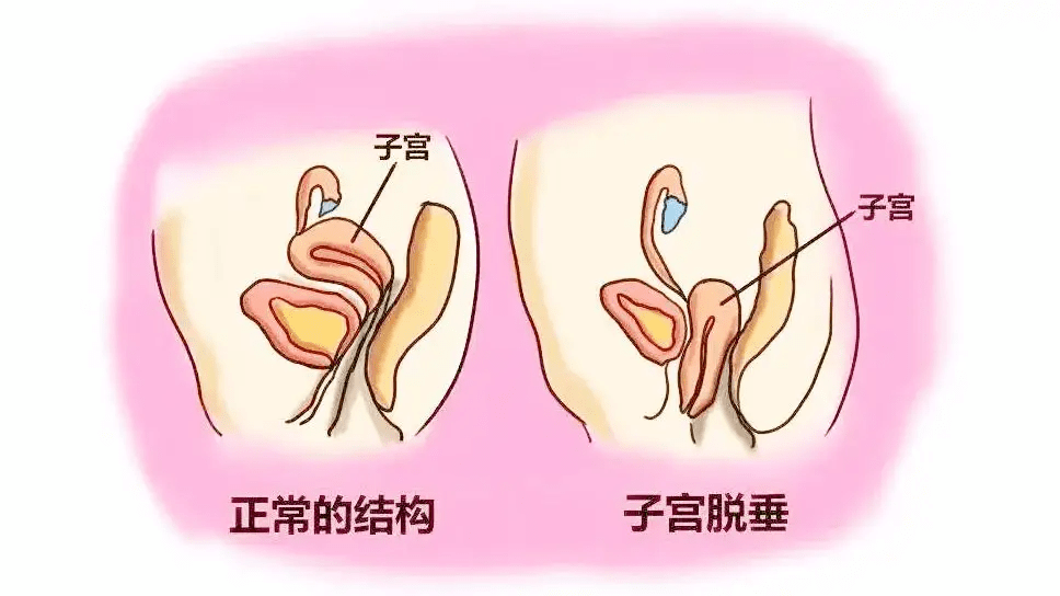 老人子宫脱落图图片