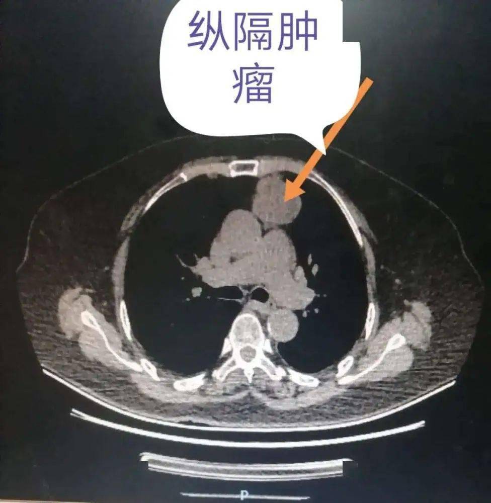 纵隔肿瘤症状图片