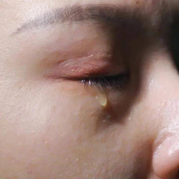 出现红眼、异物感、溢泪、视力模糊一定是患了干眼吗?_患者_眼睑_症状