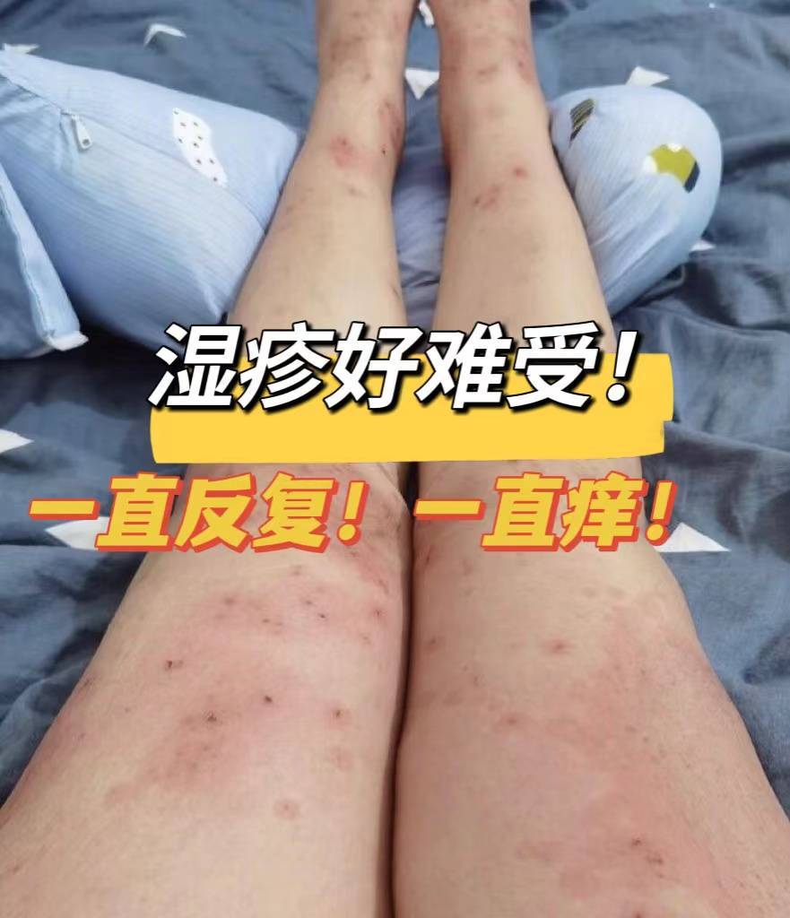顽固湿疹历时短短两月治愈!过来人究竟用的什么方法!_高考_因为_皮肤