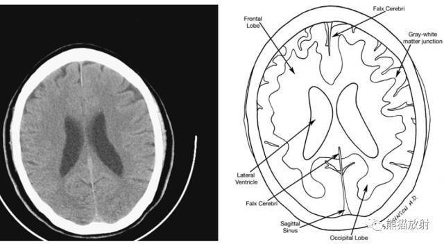 從前至後:大腦鐮,額葉,側腦室前角,尾狀核頭,基底節正常鈣化,內囊