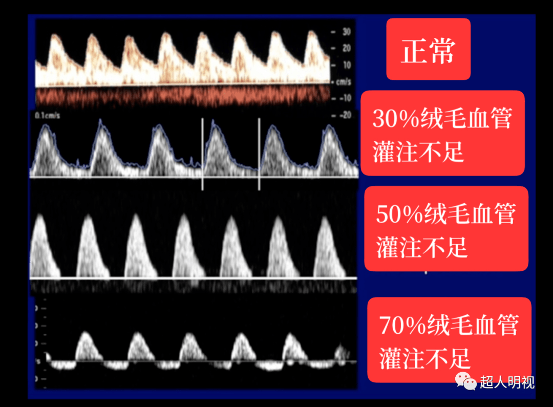 关于产科多普勒_血流_动脉_诊断