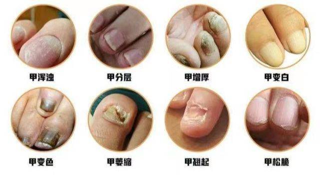 灰指甲的绝命克星来了!只需两步 轻松告别丑陋指甲!现在知道还不晚!