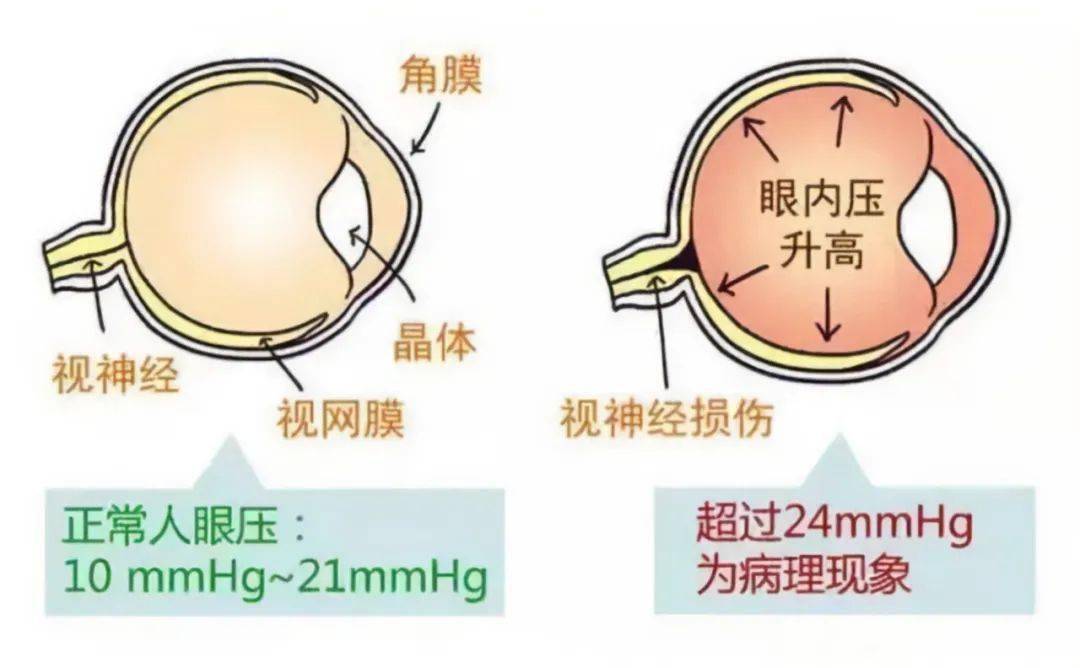 眼压24图片