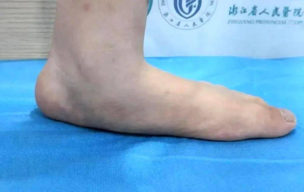 孩子行走时脚痛,跑不快,当心是扁平足!医生提醒:8-12 岁是治疗关键期