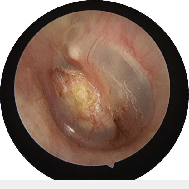 左耳鼓膜图片图片