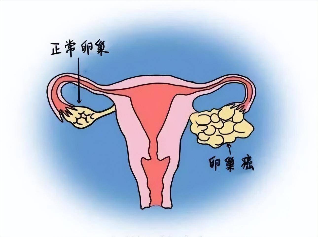 向盆腔肿块说不_恶性肿瘤_卵巢_有关