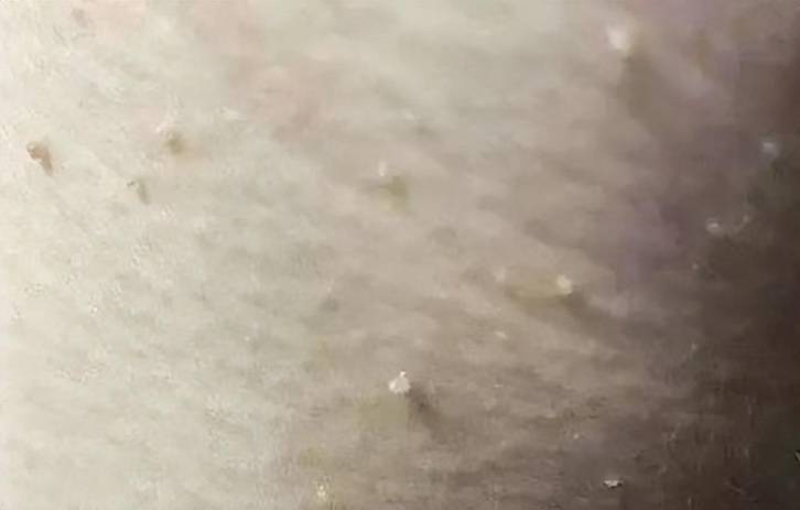 丝状疣.图自西北信息报社⑦5.