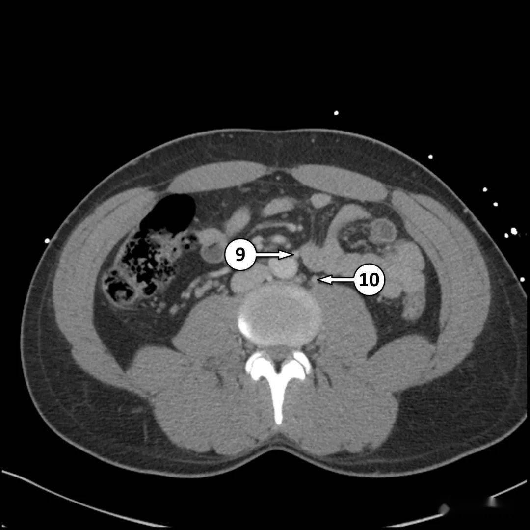 半月线4.性腺血管3.