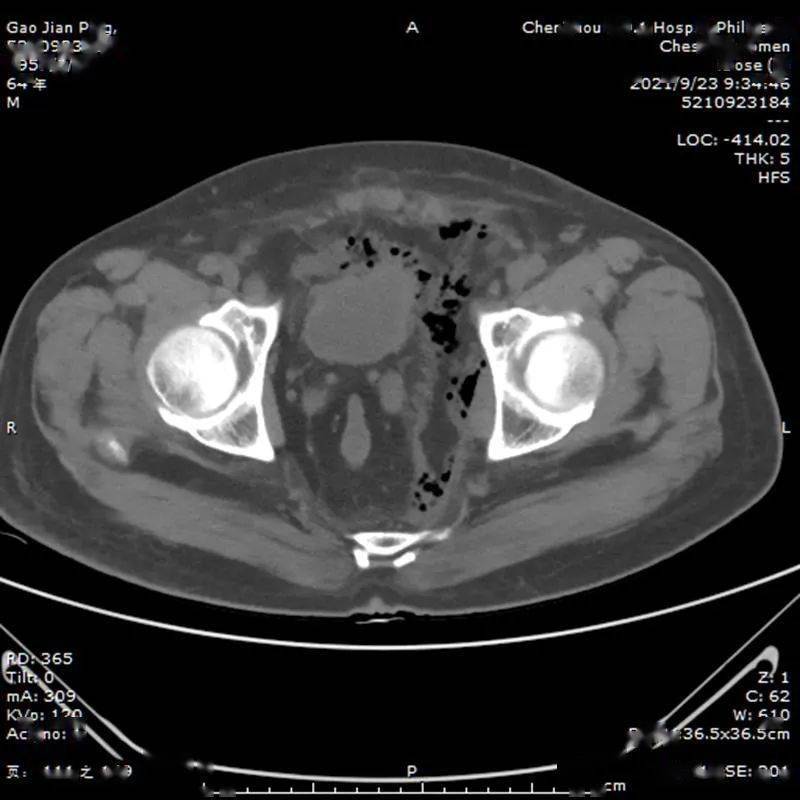 肛门和直肠的CT图图片