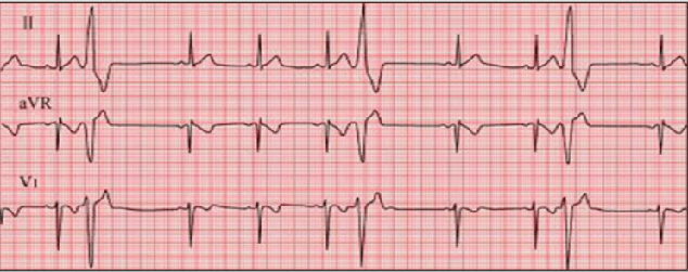 技能七大高频心电图 口诀巧记!_特点_频率_向轩