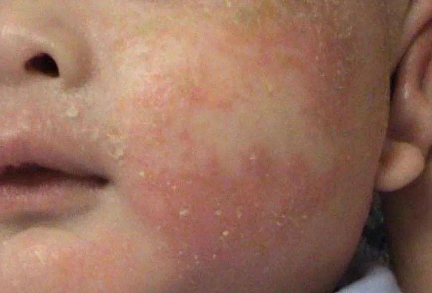 什么是儿童皮肤皴裂皮肤皴裂,是一种常见并且常发的皮肤病,皴裂表现为