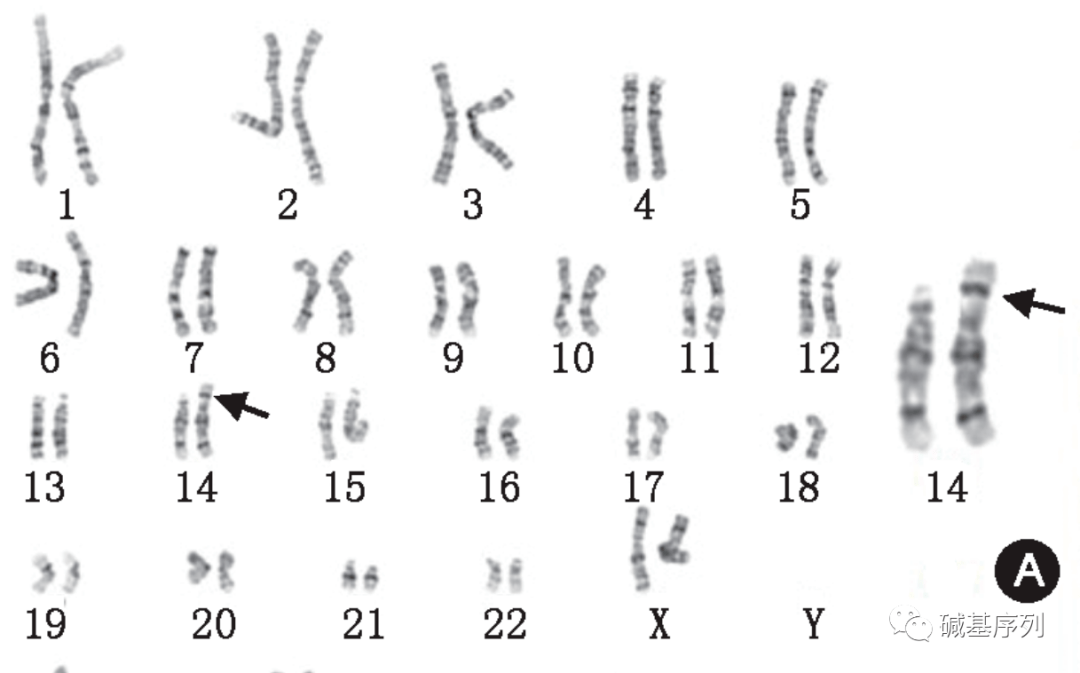 邵敏杰等(2021)报道一例因父亲的染色体倒位导致胎儿14号染色体长臂q