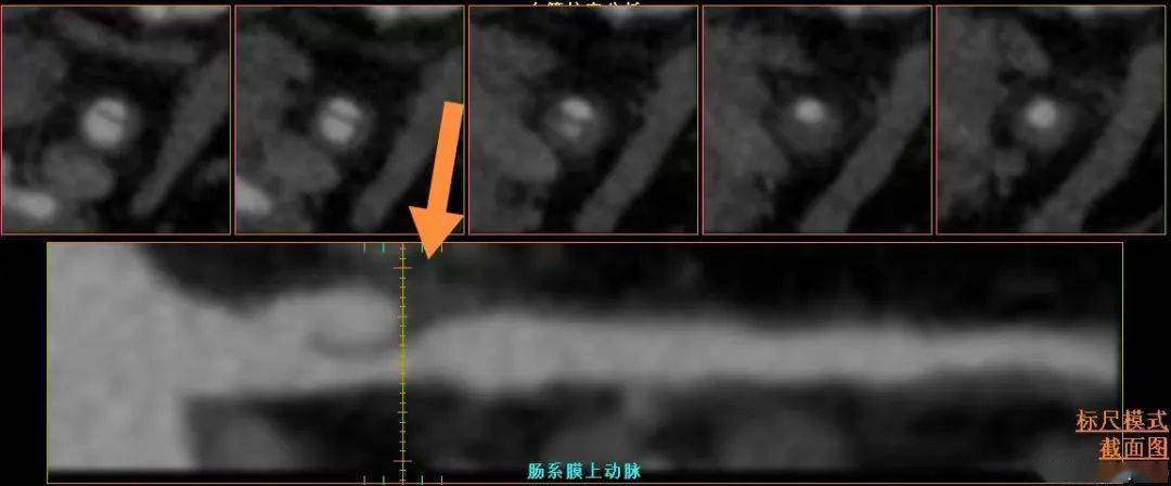 多科室携手成功完成我院首例肠系膜上动脉夹层支架置入术