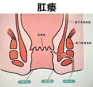 婴儿肛周脓肿初期图图片