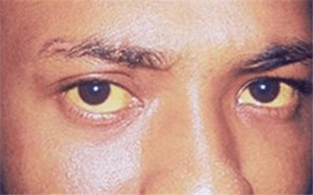 巩膜就是人的眼白部分,巩膜发黄是黄疸的标志性症状之一,原因多与血液