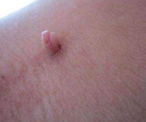 刺激你的皮肤长出这种小肉粒,当身体发现这些凸起时,一定要避免摩擦