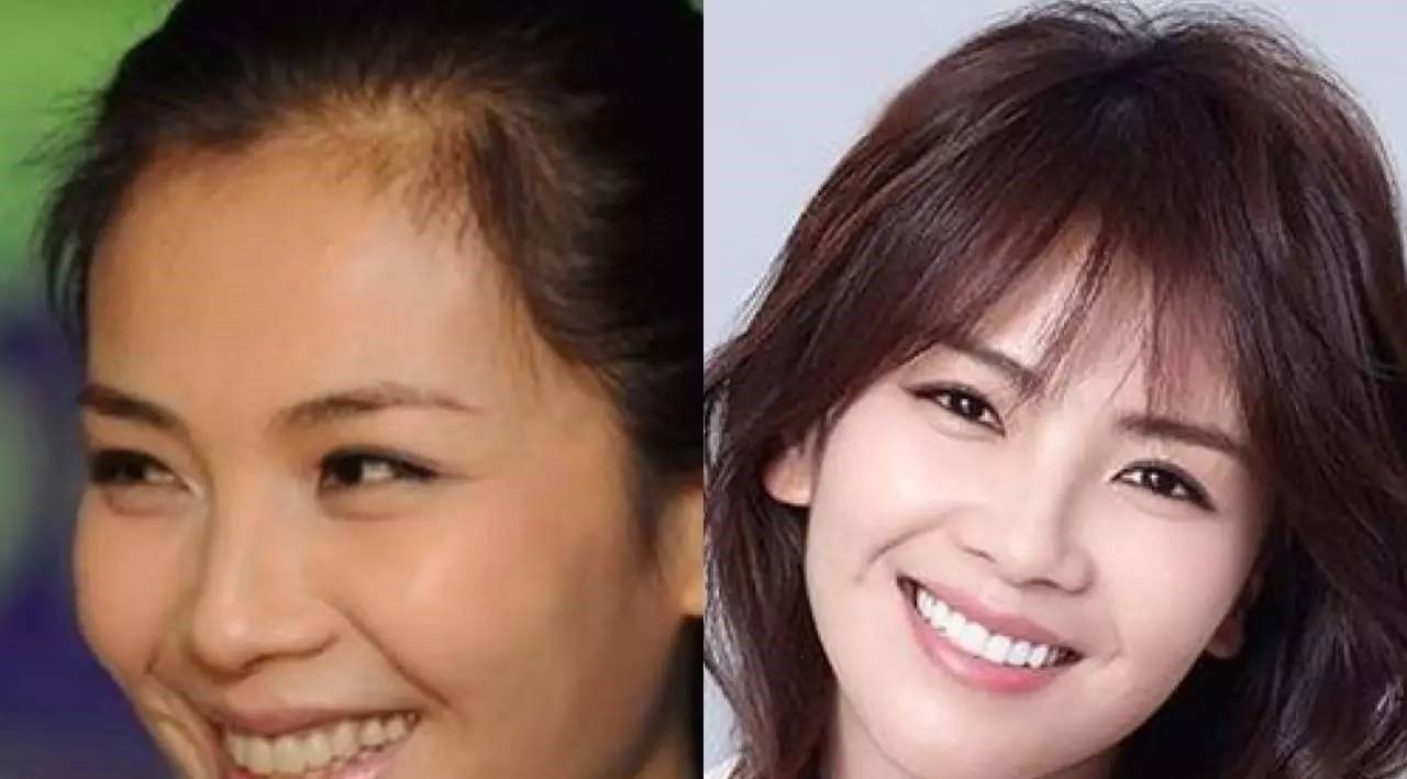 明星整牙如整容,她一口牙竟然消费300万?