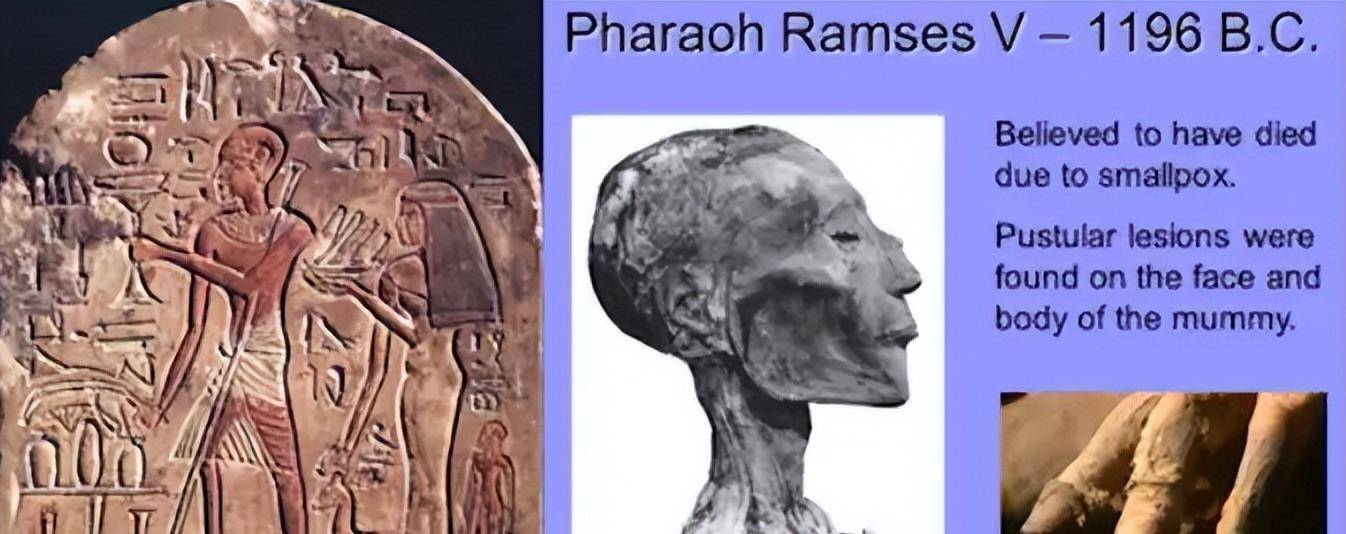 人类唯一消灭的病毒:带走数亿人,差点毁灭美洲,天花有多可怕?_疾病_顺治_罗马