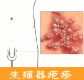 这些后果,你要了解……_生殖器_疾病_行为