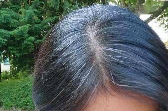 一些人的白发会出现在脑后,这可能与肾脏异常有关,特别是头发会呈灰色