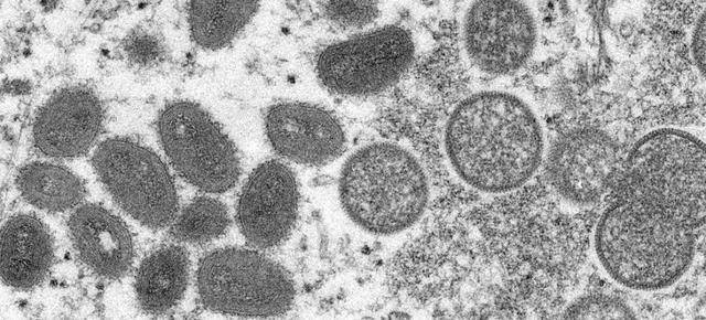重庆猴痘最新消息 重庆猴痘是怎么来的会传染开吗？