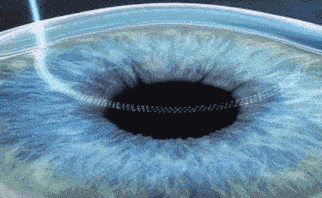 成都全飞秒、半飞秒近视手术怎么选？