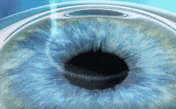 成都全飞秒、半飞秒近视手术怎么选？