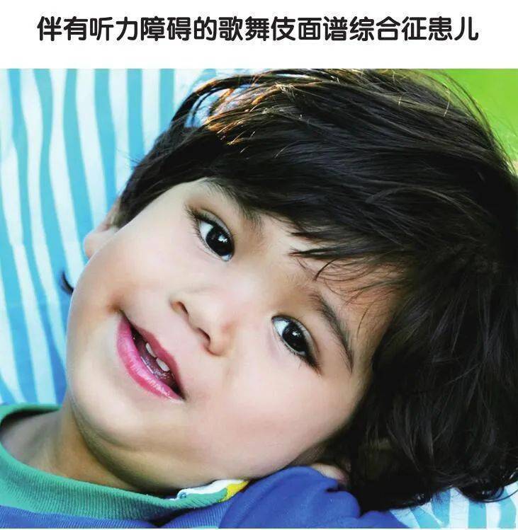 2009年,重庆医大儿童医院对外宣称,收治了我国首例歌舞伎面谱综合征