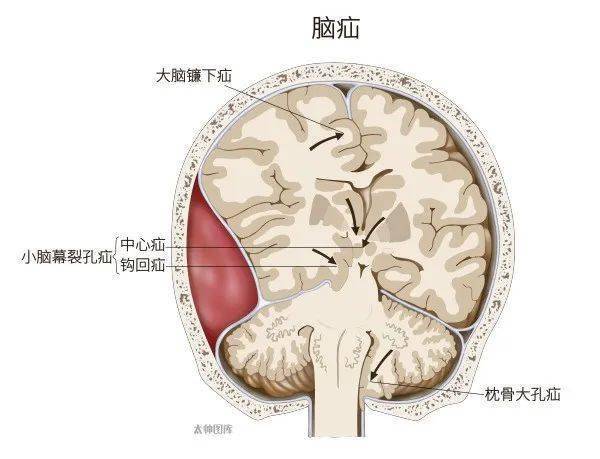 枕骨大孔疝图片