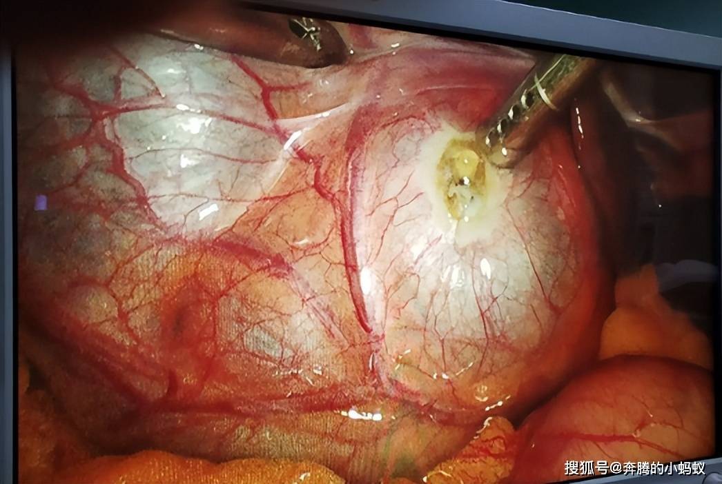 老年人肝囊肿是怎么回事,不手术对身体有没有影响?_治疗_肝脏_寄生虫