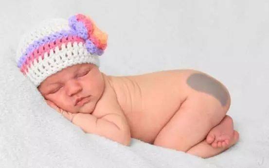 5种宝宝常见胎记大盘点,哪些可能癌变？哪些不用管,60秒辨别