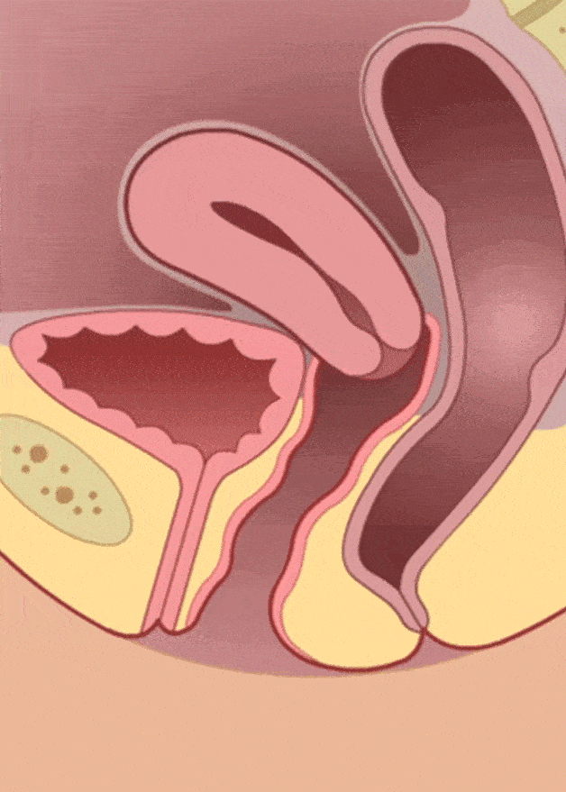 阴道前壁iii°脱垂(膀胱膨出)阴道后壁ii°脱垂(直肠膨出)主要症状