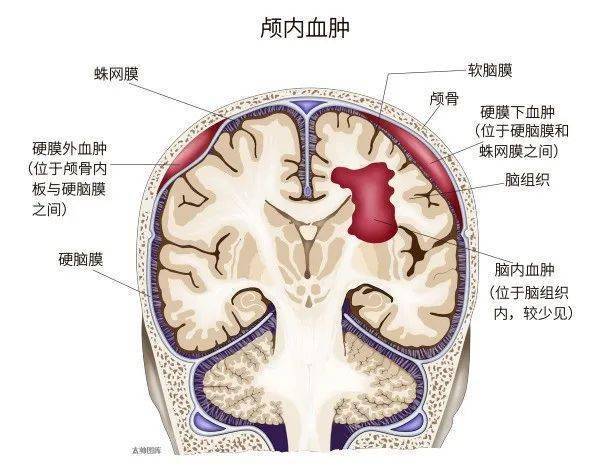 大型帽状腱膜下血肿图片