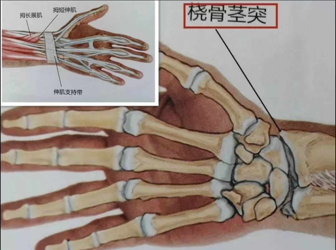 学会这几招让你轻松摆脱腱鞘炎困扰!_锻炼_时候_情况