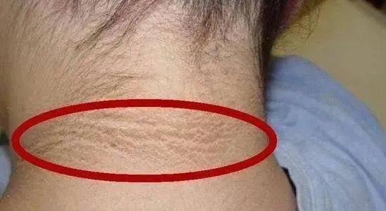 玉林15岁男孩脖子发黑,总以为是洗不干净?最终查明竟是这种疾病