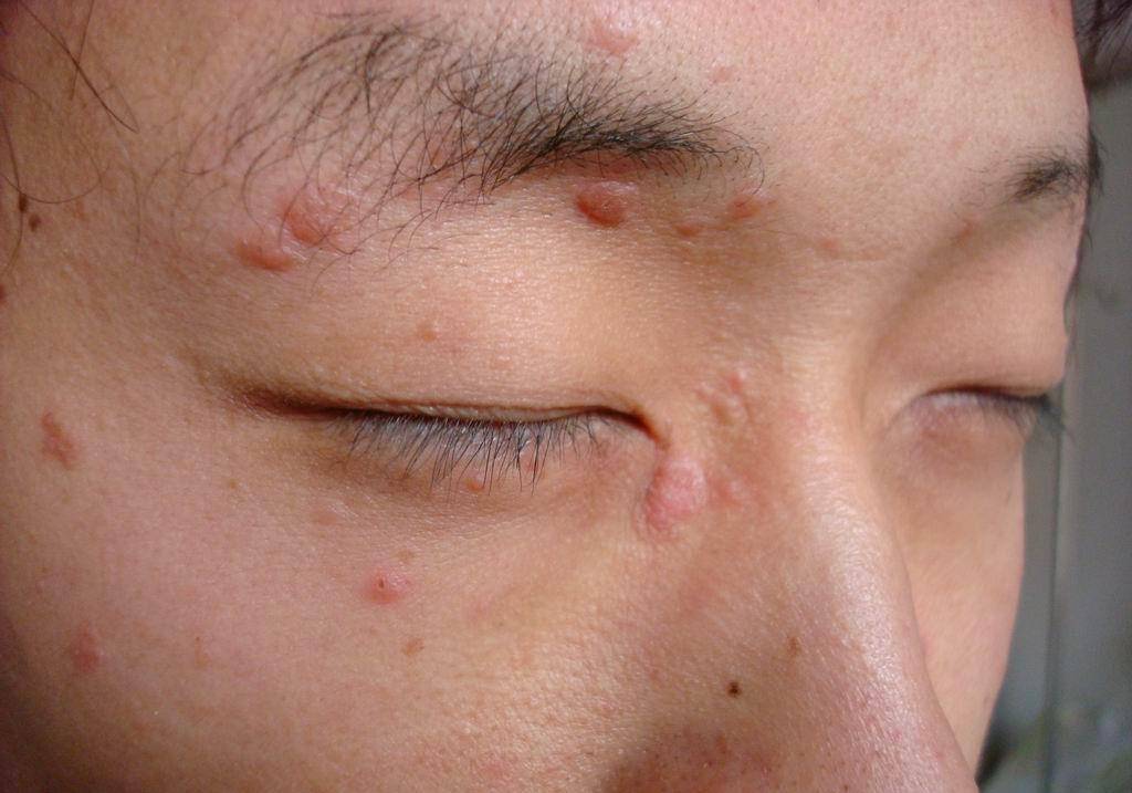 就初步判定是hpv病毒所致的扁平疣,可见他就是hpv感染者