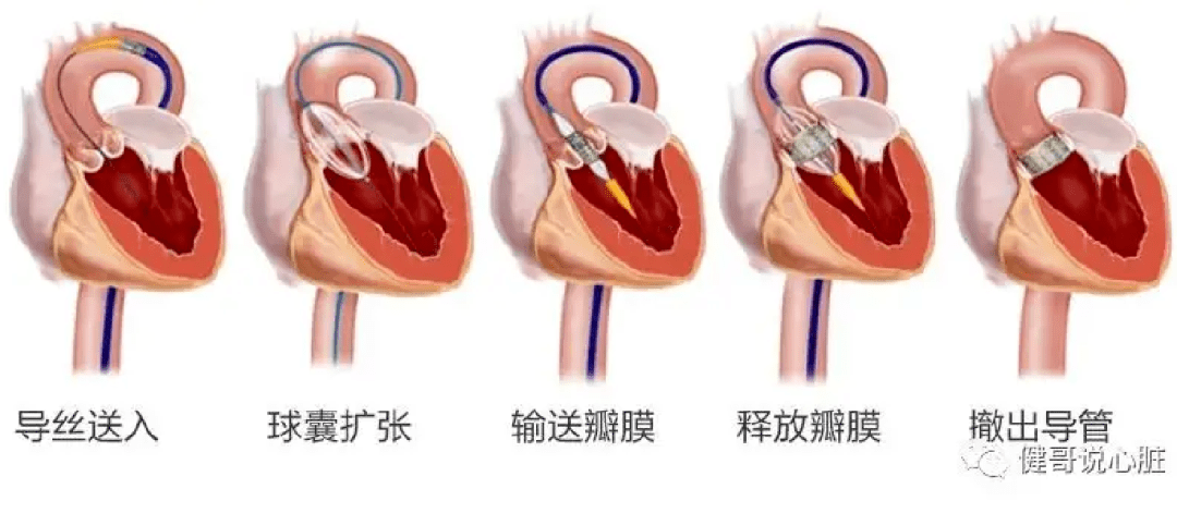 丨一例经导管主动脉瓣置换术(tavr)患者的麻醉体会_心功能_检查_瓣膜