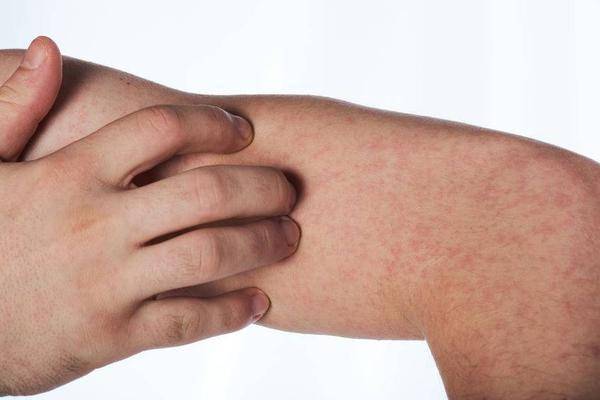 为什么秋冬季节荨麻疹容易复发？这可能和四个因素有关，做好三件事可以缓解不适。