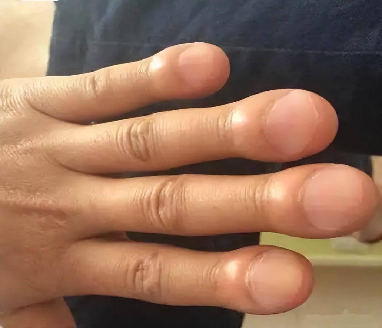 杵状指头是什么病图片