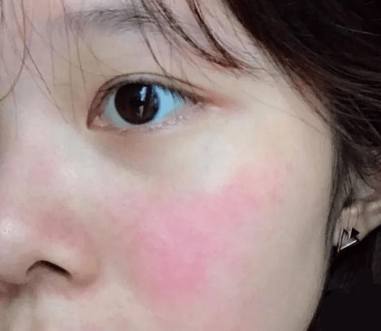 塑颜工匠|又油又敏感是什么肤质?如何护理?_肌肤_护肤品_症状