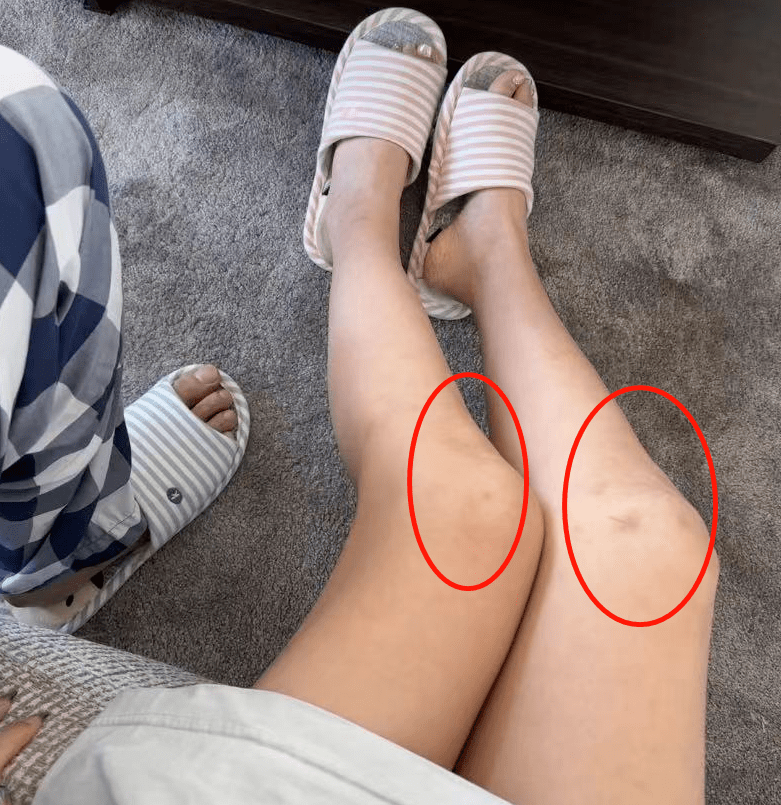 穿短裙光着一双大长腿,膝盖上淤青太抢镜_慎婕_横店_信息