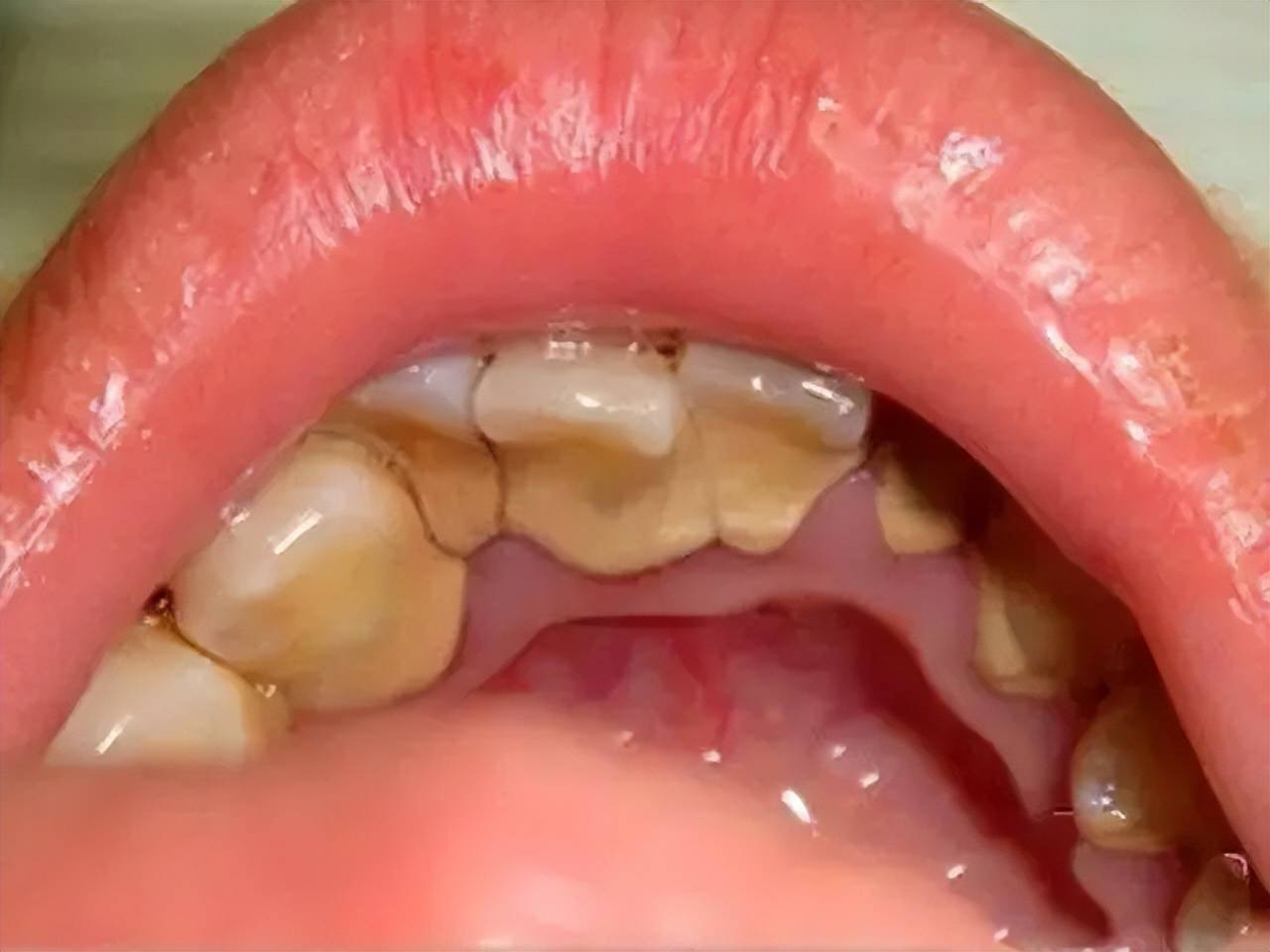 牙结石能去掉吗?每天只要几毛钱,烂牙变新牙成片牙结石刷刷掉!