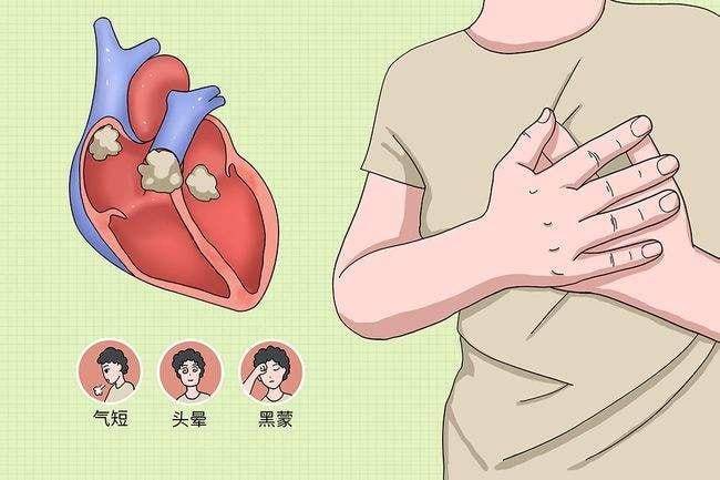 风湿性心肌炎的临床特点 全面了解该病的症状表现