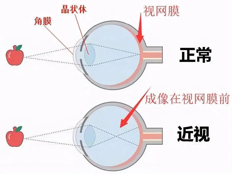 熟知哺光儀,近視的孩子用得上_視網膜_眼底_紅光