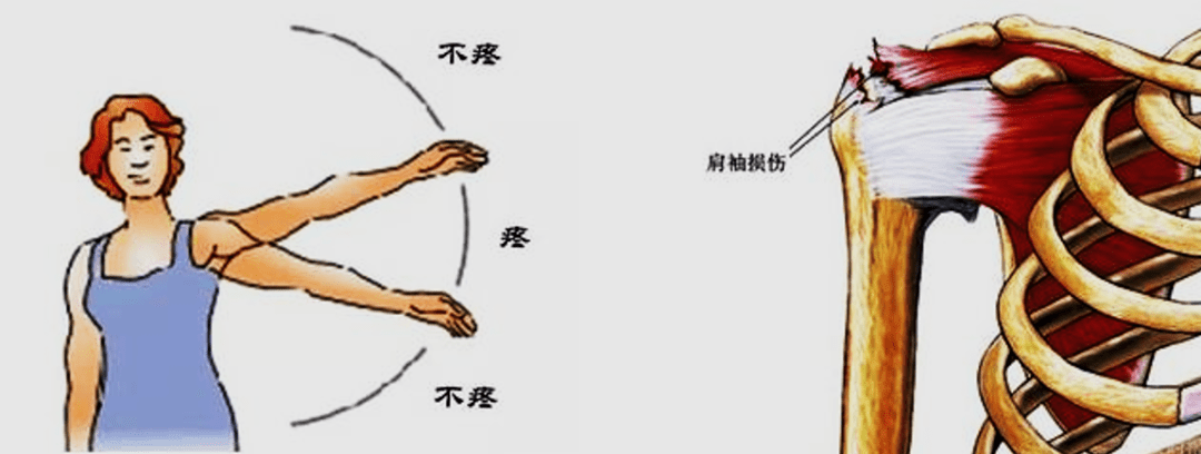 肩袖损伤位置图片图片